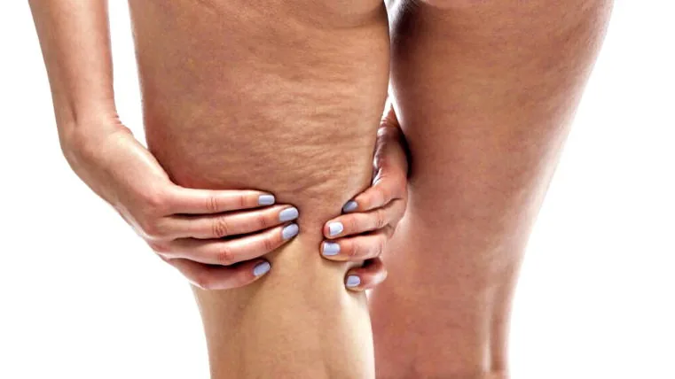 Stretch mark karena peregangan otot