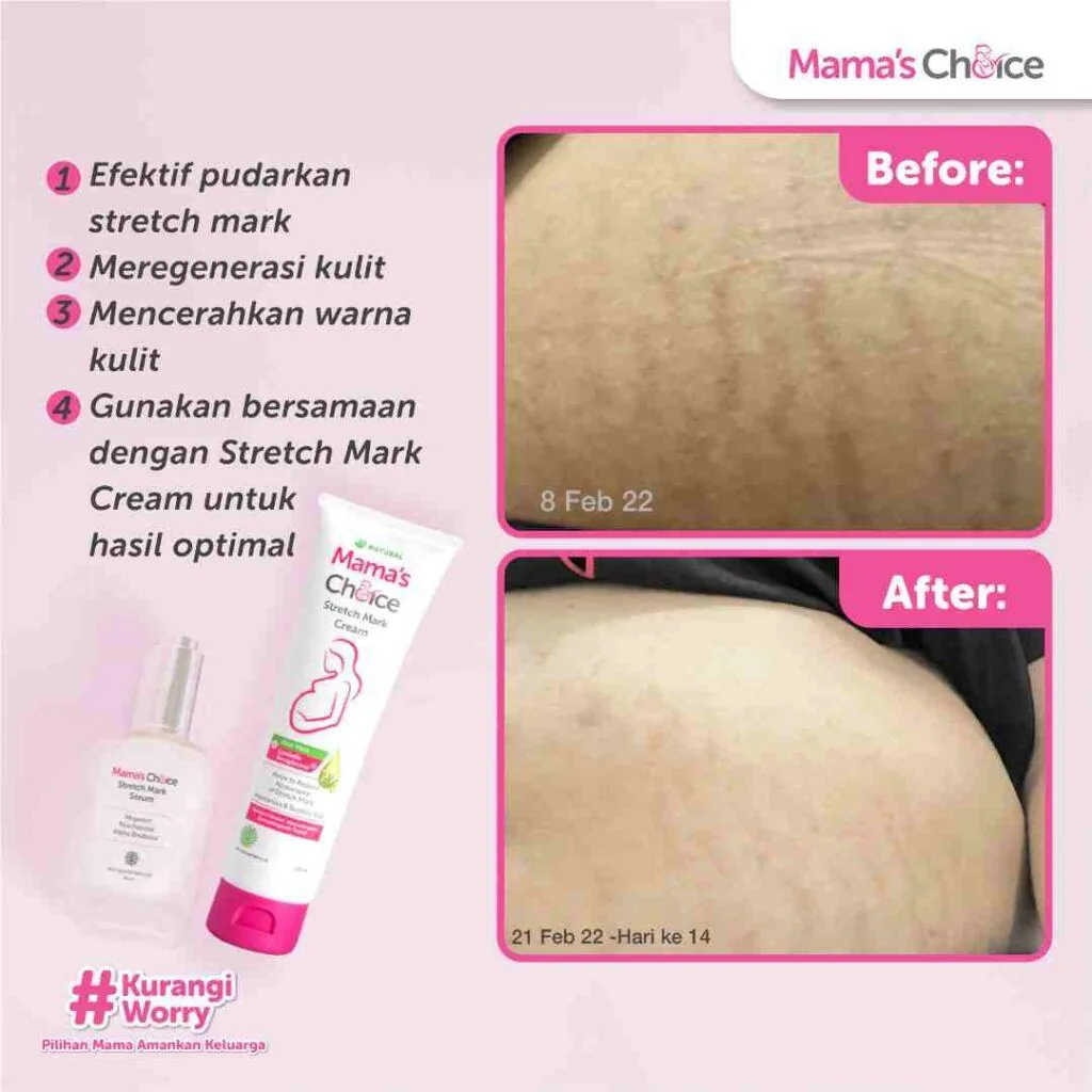 Testimoni Penggunaan Rangkaian Stretch Mark Series dari Mama