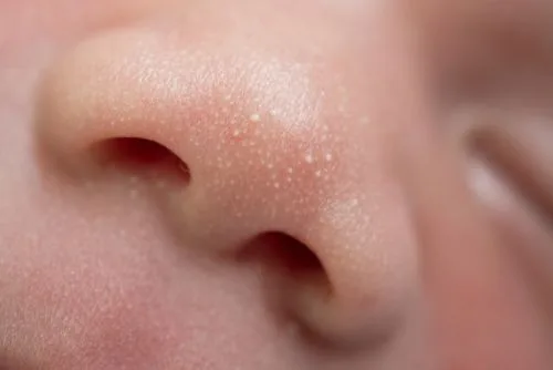 bruntusan pada bayi