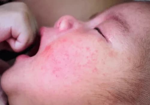 Ruam merah biduran di wajah bayi