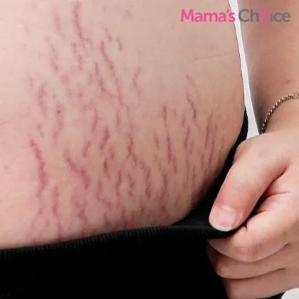 stretch mark