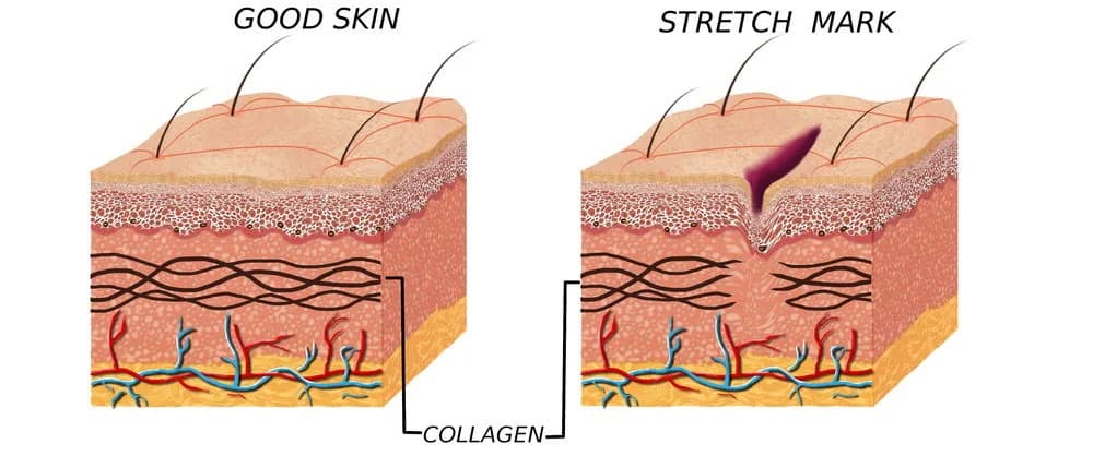 Penyebab Stretch Mark Muncul Setelah Melahirkan