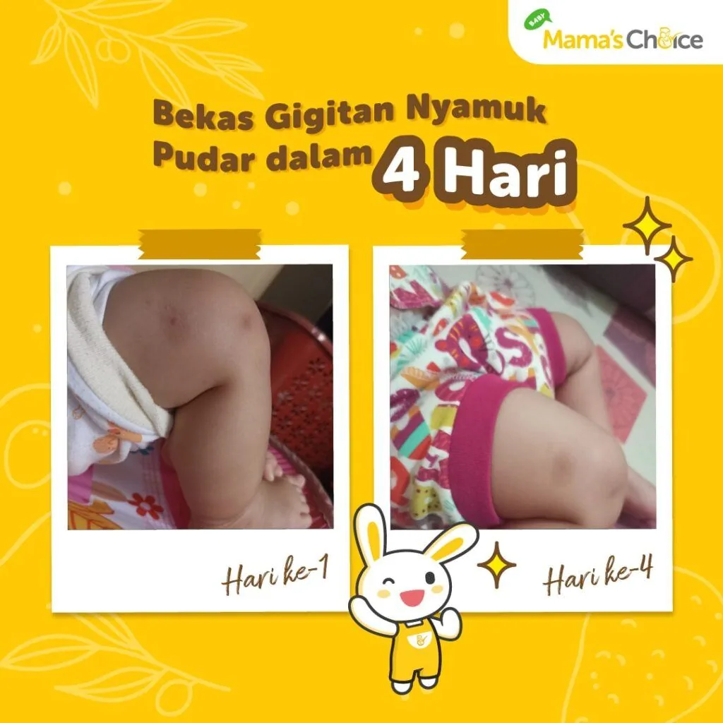 Atasi Bekas Darah Manis Pada Anak dengan Produk yang Tepat!