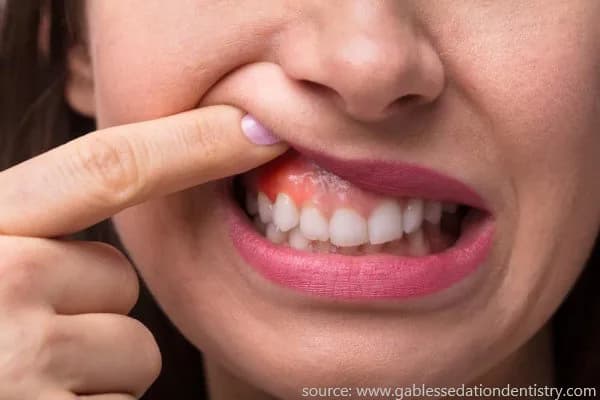 epulis gradivarum adalah gusi bengkak saat hamil