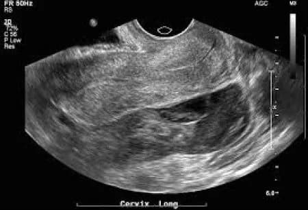Gambar USG Kantung Janin yang Abnormal