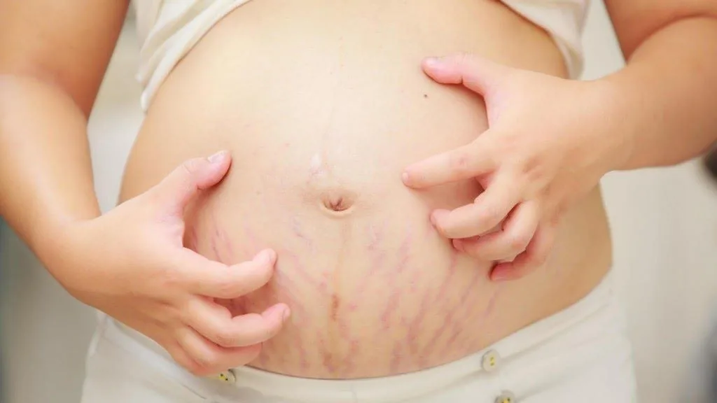 Stretch Mark di perut