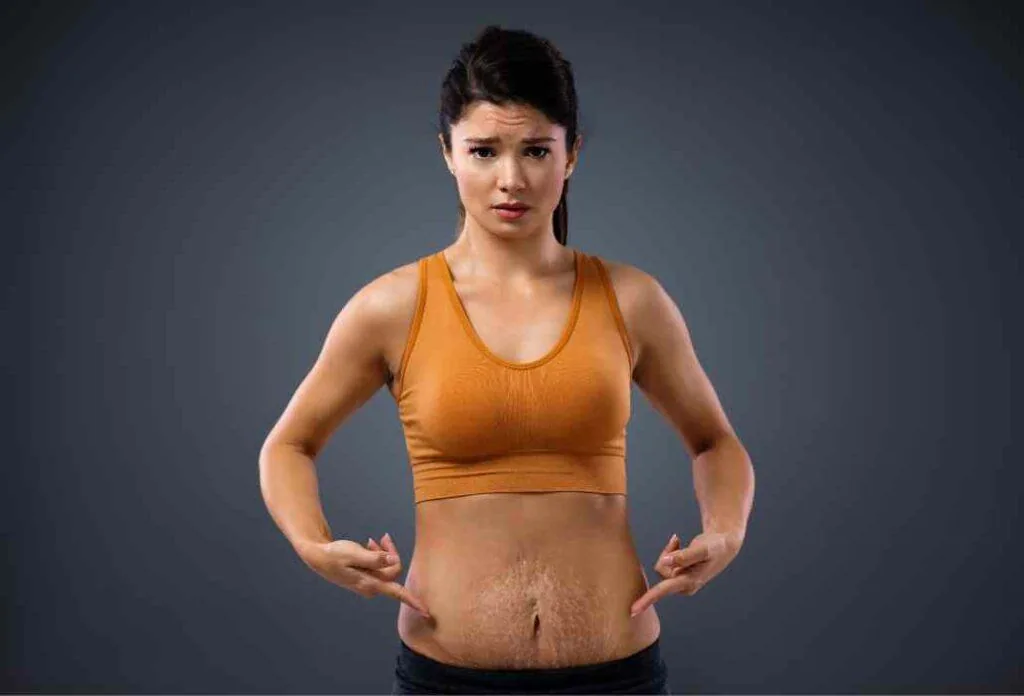 Cara Mempercepat Hilangnya Stretch Mark