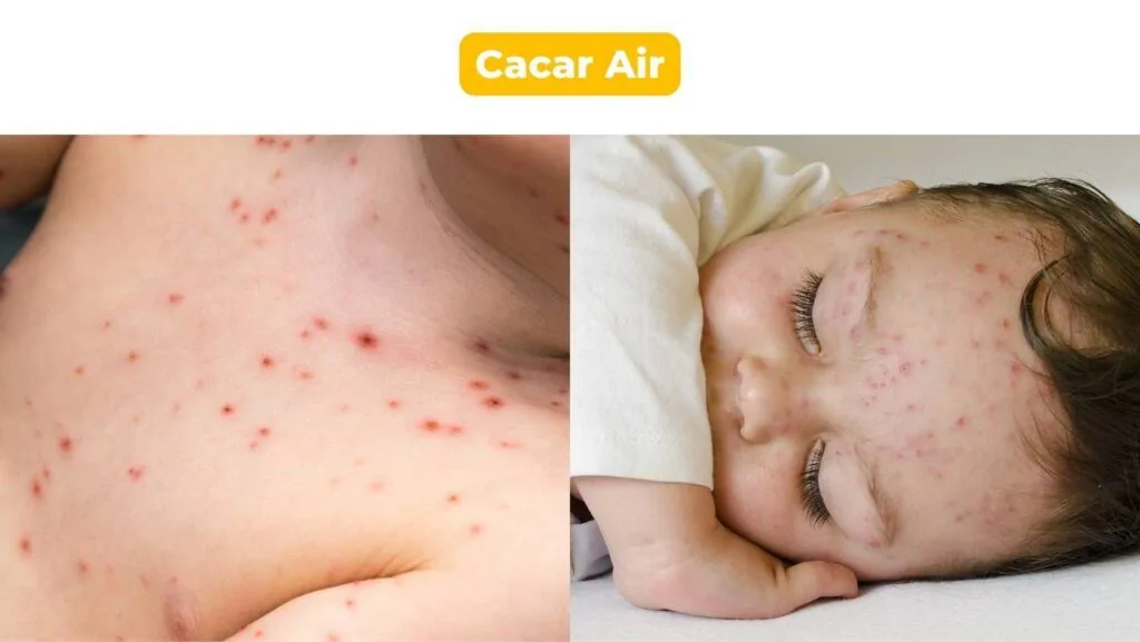 Cacar air pada bayi