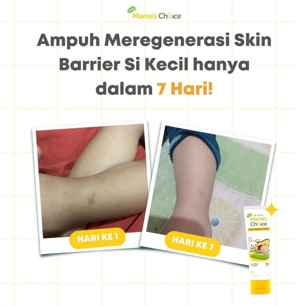 Hindari Penyakit Kulit, Pastikan Kulit Si Kecil Ternutrisi dengan Baik!