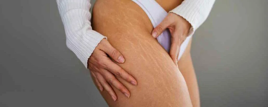 A teenager looking at stretch marks on her skin
