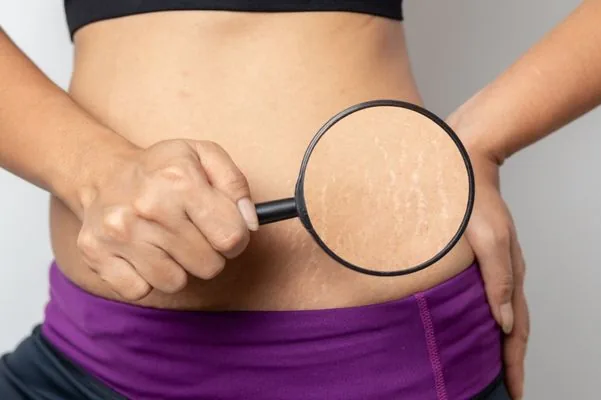 Penyebab Stretch Mark