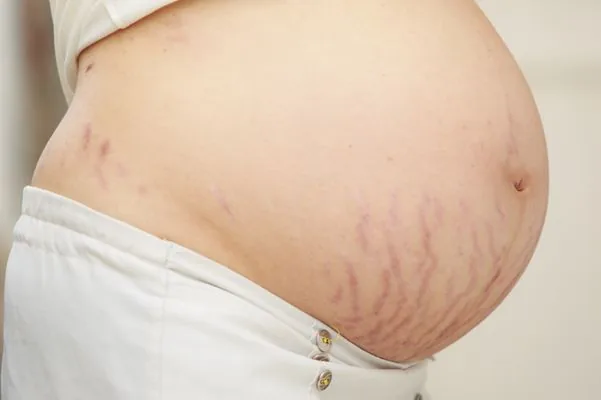 Stretch Mark Berwarna Merah (Striae Rurbae)