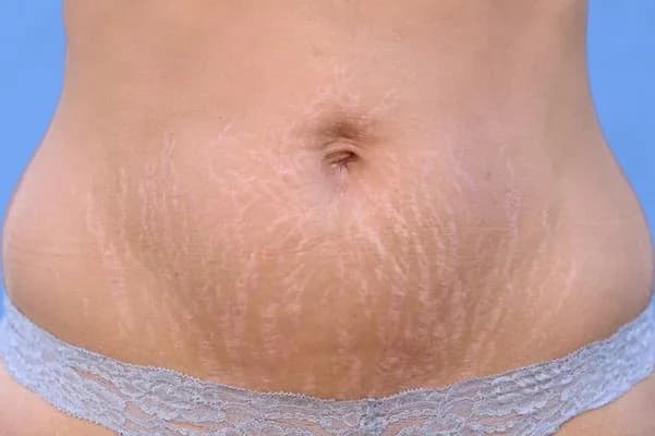 Stretch Mark Berwarna Putih (Striae Albae)