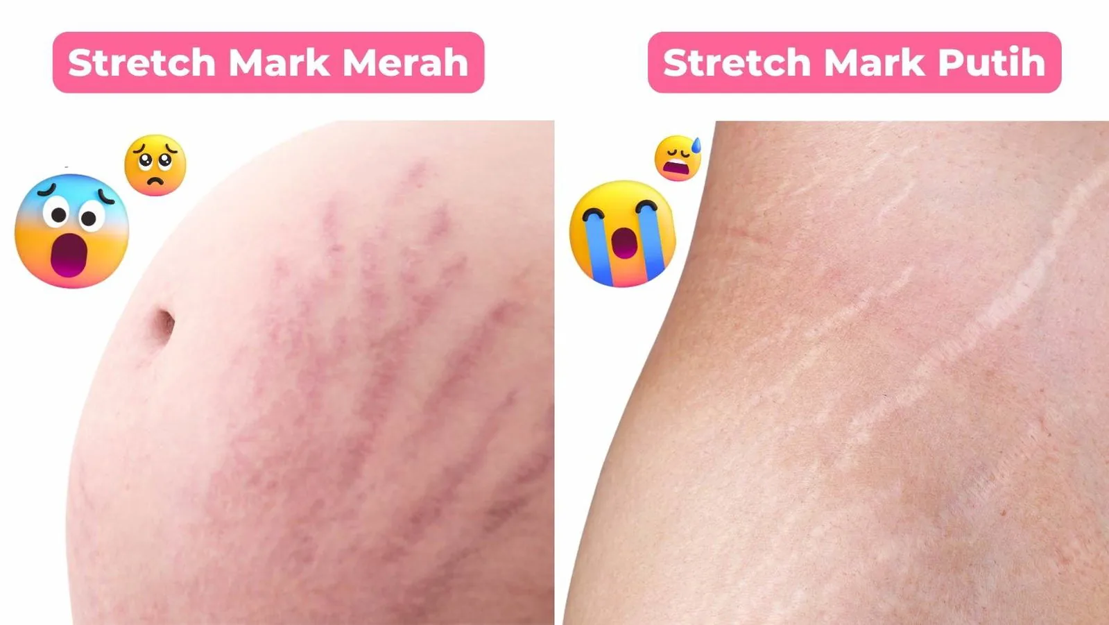 perbedaan stretch mark merah dan putih