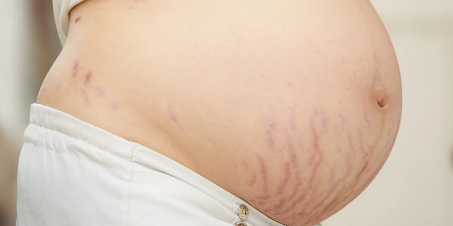 Stretch Mark Merah Saat Hamil