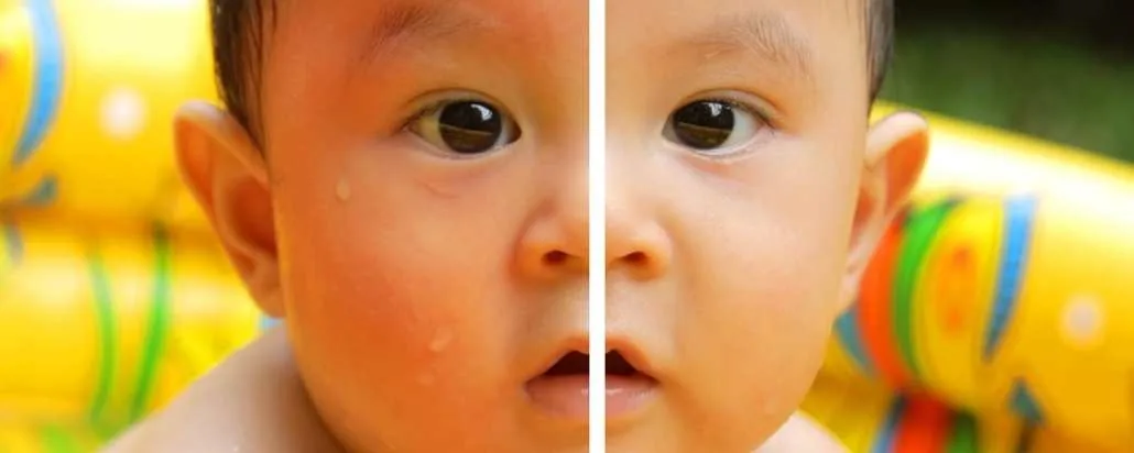 kulit bayi terbakar